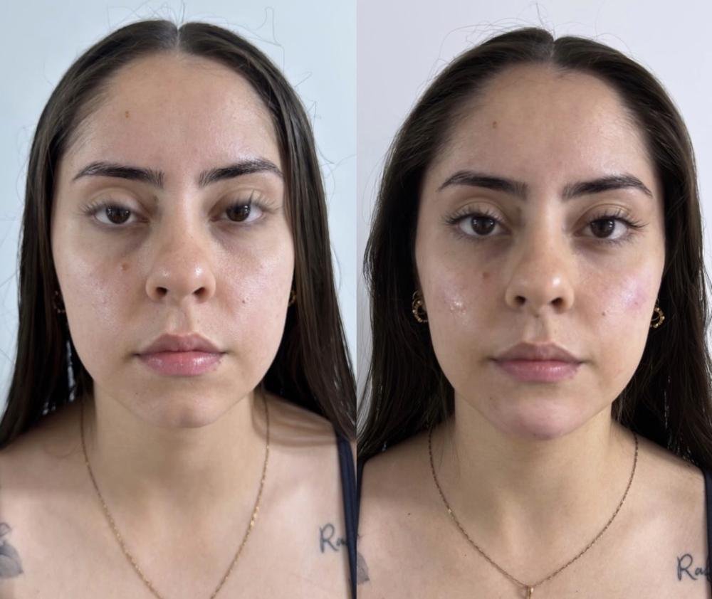 Harmonização facial – antes e depois