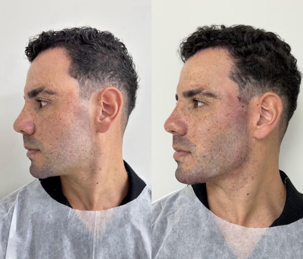 Harmonização masculina – antes e depois