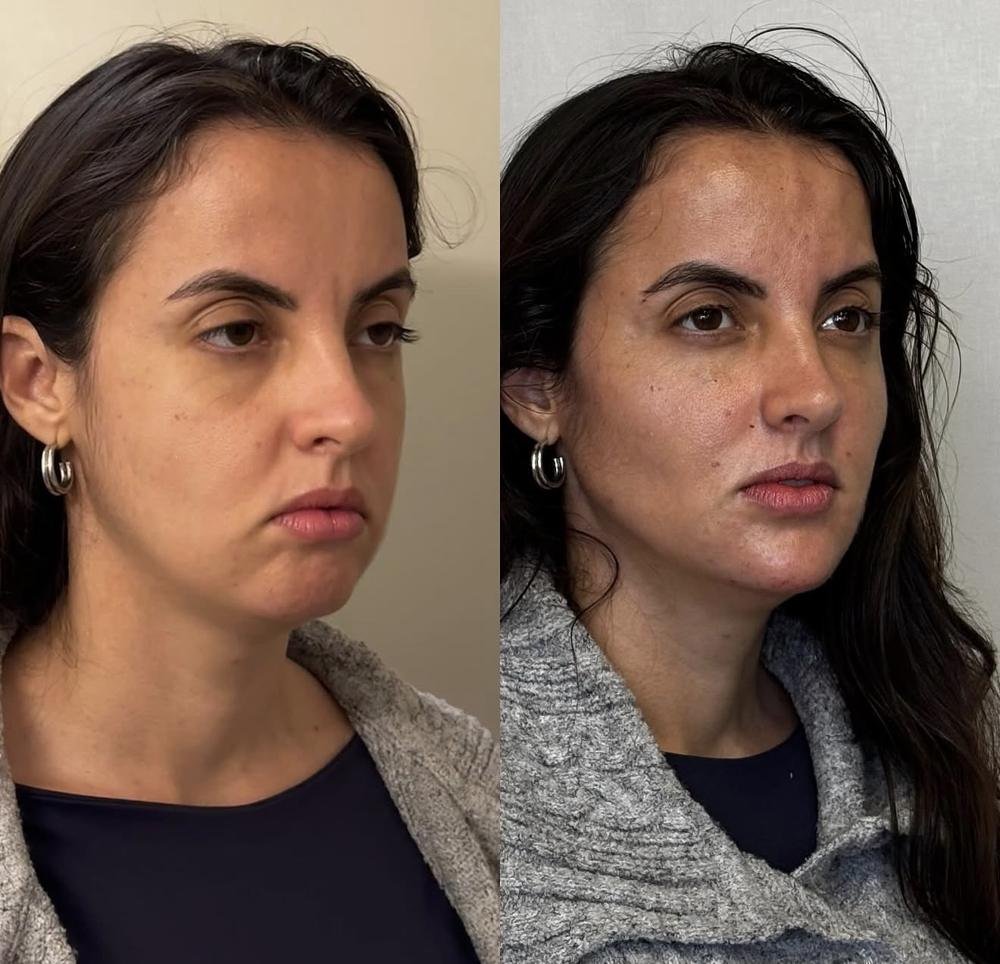 Contorno facial – antes e depois