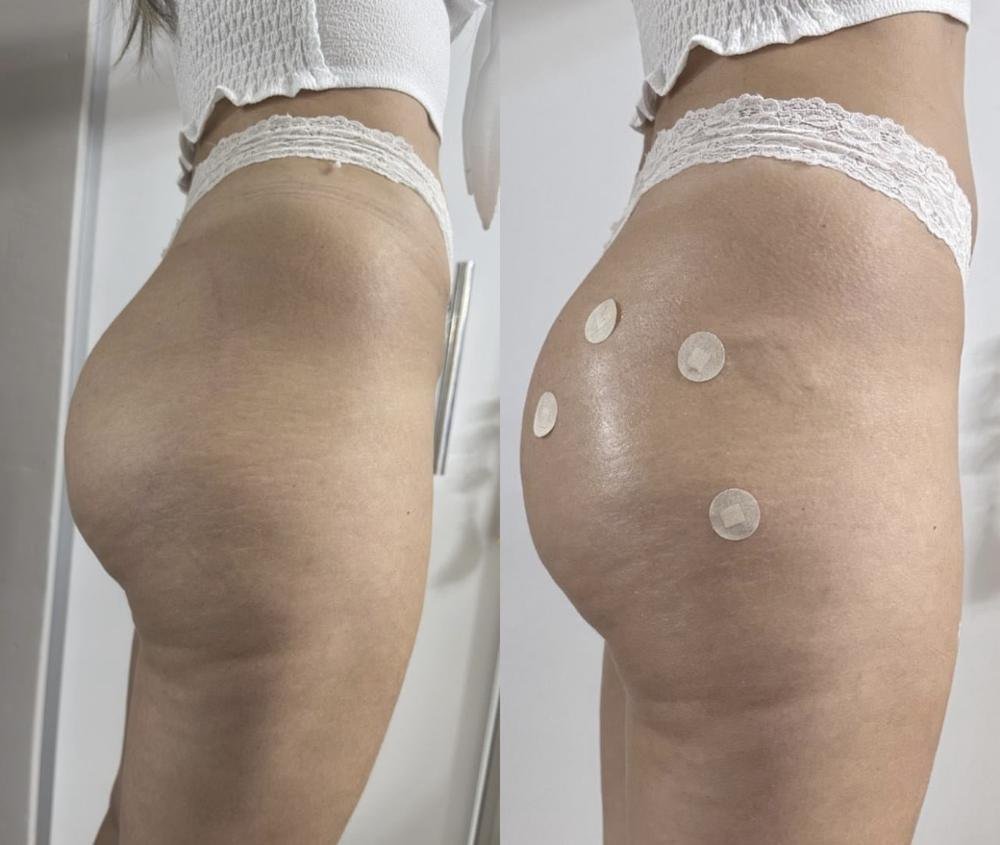 Harmonização glútea – antes e depois