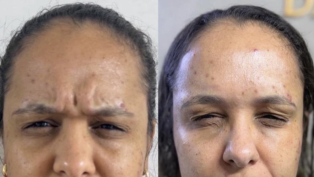 Toxina botulínica – antes e depois
