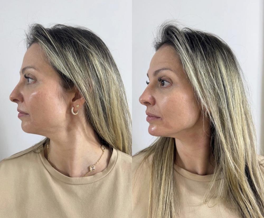 Contorno de mandíbula – antes e depois