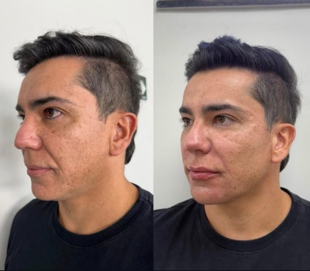 Harmonização masculina – antes e depois