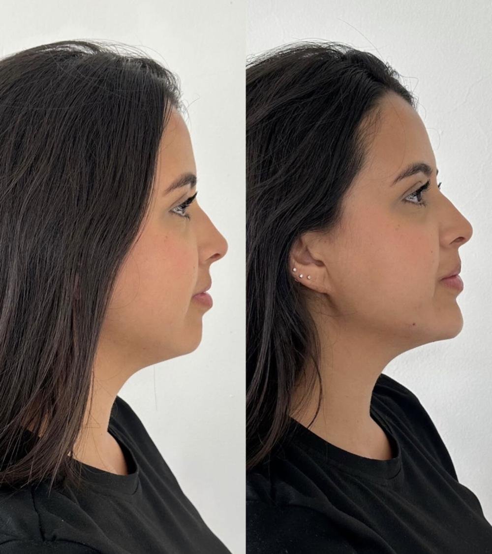Perfil e mento – antes e depois