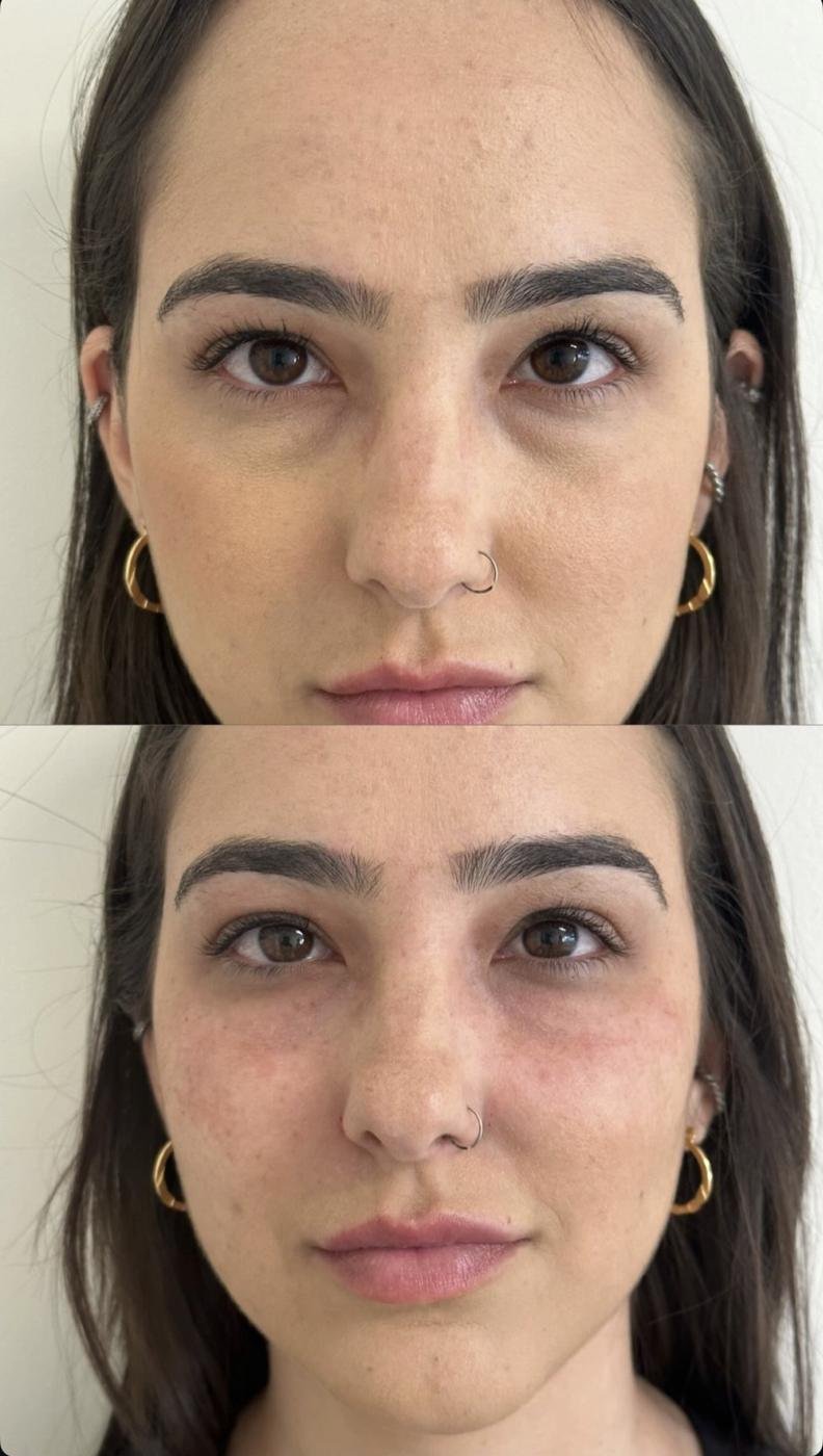 Olheiras e malar – antes e depois
